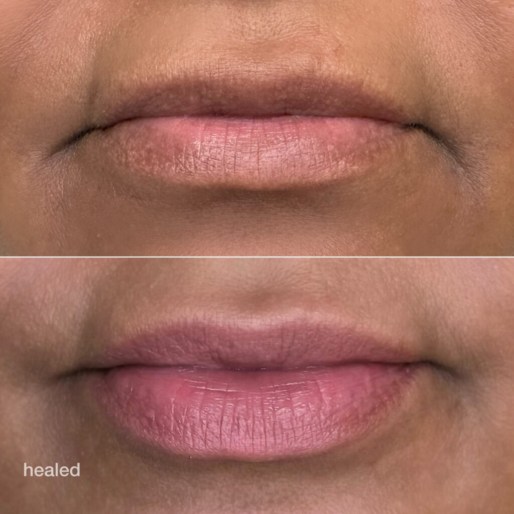 Dark lip coloring in Egypt - Before and after - Rabab Kelani